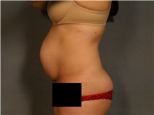 Tummy Tuck Before Photo by Ellen Janetzke, MD; Bloomfield Hills, MI - Case 36998