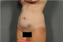 Tummy Tuck Before Photo by Ellen Janetzke, MD; Bloomfield Hills, MI - Case 36999