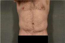 Tummy Tuck After Photo by Ellen Janetzke, MD; Bloomfield Hills, MI - Case 37000