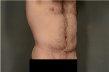 Tummy Tuck After Photo by Ellen Janetzke, MD; Bloomfield Hills, MI - Case 37000