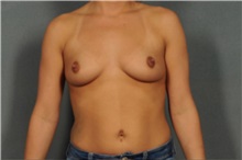 Breast Augmentation Before Photo by Ellen Janetzke, MD; Bloomfield Hills, MI - Case 37327