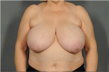 Breast Reduction Before Photo by Ellen Janetzke, MD; Bloomfield Hills, MI - Case 37328