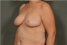 Breast Reduction After Photo by Ellen Janetzke, MD; Bloomfield Hills, MI - Case 37328