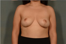 Breast Lift After Photo by Ellen Janetzke, MD; Bloomfield Hills, MI - Case 37329
