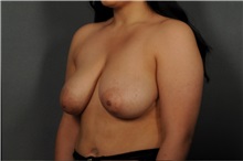 Breast Lift Before Photo by Ellen Janetzke, MD; Bloomfield Hills, MI - Case 37329