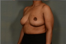 Breast Reduction After Photo by Ellen Janetzke, MD; Bloomfield Hills, MI - Case 37595