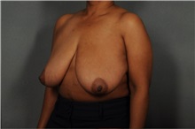 Breast Reduction Before Photo by Ellen Janetzke, MD; Bloomfield Hills, MI - Case 37595