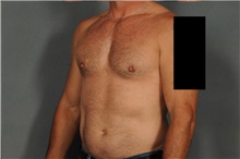 Male Breast Reduction After Photo by Ellen Janetzke, MD; Bloomfield Hills, MI - Case 37596