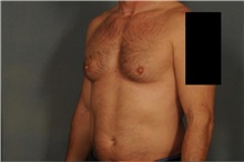 Male Breast Reduction Before Photo by Ellen Janetzke, MD; Bloomfield Hills, MI - Case 37596