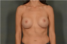 Breast Augmentation After Photo by Ellen Janetzke, MD; Bloomfield Hills, MI - Case 37638