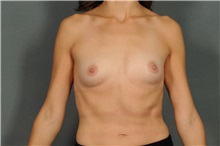 Breast Augmentation Before Photo by Ellen Janetzke, MD; Bloomfield Hills, MI - Case 37638