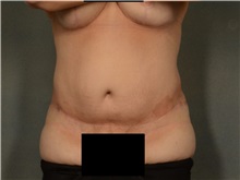 Tummy Tuck After Photo by Ellen Janetzke, MD; Bloomfield Hills, MI - Case 37640