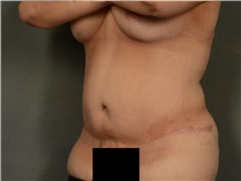 Tummy Tuck After Photo by Ellen Janetzke, MD; Bloomfield Hills, MI - Case 37640
