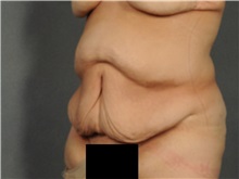 Tummy Tuck Before Photo by Ellen Janetzke, MD; Bloomfield Hills, MI - Case 37640