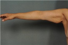 Arm Lift Before Photo by Ellen Janetzke, MD; Bloomfield Hills, MI - Case 37642