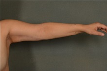 Arm Lift After Photo by Ellen Janetzke, MD; Bloomfield Hills, MI - Case 37642
