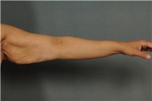 Arm Lift Before Photo by Ellen Janetzke, MD; Bloomfield Hills, MI - Case 37642
