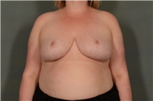 Breast Reduction After Photo by Ellen Janetzke, MD; Bloomfield Hills, MI - Case 37833
