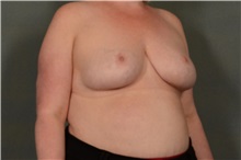 Breast Reduction After Photo by Ellen Janetzke, MD; Bloomfield Hills, MI - Case 37833
