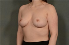 Breast Reduction After Photo by Ellen Janetzke, MD; Bloomfield Hills, MI - Case 37834