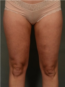 Liposuction After Photo by Ellen Janetzke, MD; Bloomfield Hills, MI - Case 38554
