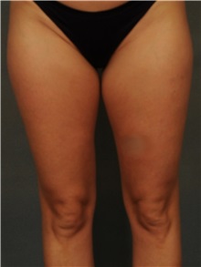 Liposuction Before Photo by Ellen Janetzke, MD; Bloomfield Hills, MI - Case 38554