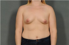 Breast Augmentation Before Photo by Ellen Janetzke, MD; Bloomfield Hills, MI - Case 38555