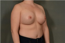 Breast Augmentation After Photo by Ellen Janetzke, MD; Bloomfield Hills, MI - Case 38555