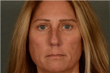 Eyelid Surgery After Photo by Ellen Janetzke, MD; Bloomfield Hills, MI - Case 38556