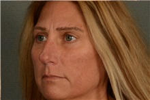 Eyelid Surgery After Photo by Ellen Janetzke, MD; Bloomfield Hills, MI - Case 38556