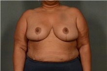 Breast Reduction After Photo by Ellen Janetzke, MD; Bloomfield Hills, MI - Case 38557