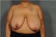 Breast Reduction Before Photo by Ellen Janetzke, MD; Bloomfield Hills, MI - Case 38557