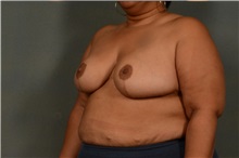 Breast Reduction After Photo by Ellen Janetzke, MD; Bloomfield Hills, MI - Case 38557