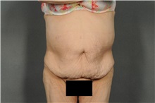 Tummy Tuck Before Photo by Ellen Janetzke, MD; Bloomfield Hills, MI - Case 38558