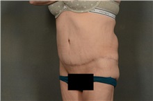 Tummy Tuck After Photo by Ellen Janetzke, MD; Bloomfield Hills, MI - Case 38558
