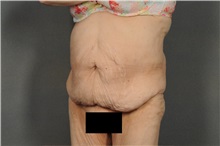 Tummy Tuck Before Photo by Ellen Janetzke, MD; Bloomfield Hills, MI - Case 38558