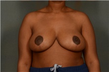 Breast Reduction After Photo by Ellen Janetzke, MD; Bloomfield Hills, MI - Case 38760