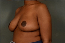 Breast Reduction After Photo by Ellen Janetzke, MD; Bloomfield Hills, MI - Case 38760