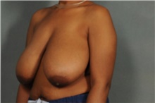 Breast Reduction Before Photo by Ellen Janetzke, MD; Bloomfield Hills, MI - Case 38760
