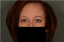 Eyelid Surgery After Photo by Ellen Janetzke, MD; Bloomfield Hills, MI - Case 38761