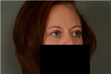 Eyelid Surgery After Photo by Ellen Janetzke, MD; Bloomfield Hills, MI - Case 38761