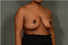 Breast Reduction After Photo by Ellen Janetzke, MD; Bloomfield Hills, MI - Case 38859