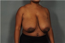 Breast Reduction Before Photo by Ellen Janetzke, MD; Bloomfield Hills, MI - Case 38859