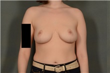 Breast Reduction After Photo by Ellen Janetzke, MD; Bloomfield Hills, MI - Case 39552