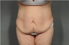 Tummy Tuck Before Photo by Ellen Janetzke, MD; Bloomfield Hills, MI - Case 39554