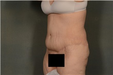 Tummy Tuck After Photo by Ellen Janetzke, MD; Bloomfield Hills, MI - Case 39554