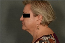 Liposuction After Photo by Ellen Janetzke, MD; Bloomfield Hills, MI - Case 39555