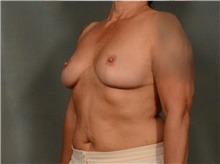 Breast Reduction After Photo by Ellen Janetzke, MD; Bloomfield Hills, MI - Case 40908