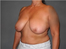 Breast Reduction Before Photo by Ellen Janetzke, MD; Bloomfield Hills, MI - Case 40908