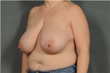 Breast Reduction Before Photo by Ellen Janetzke, MD; Bloomfield Hills, MI - Case 40909